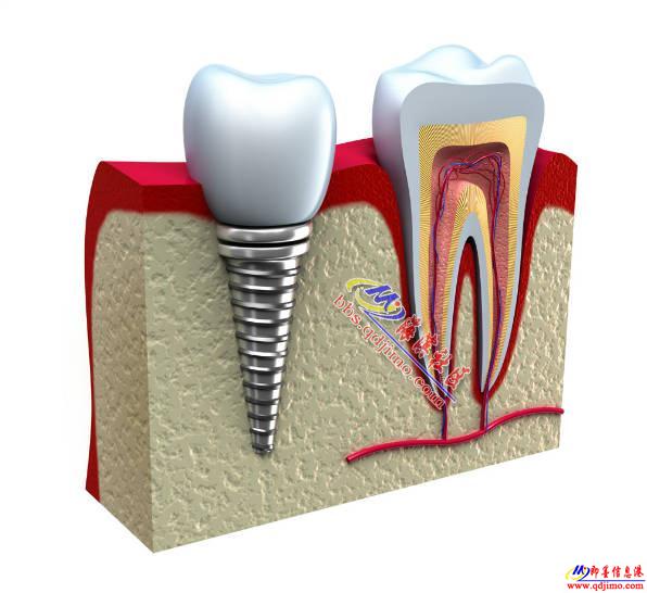 西诺德口腔种植牙的优点与优势 - 通济其它服务