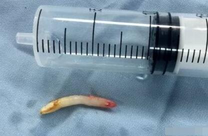 男孩鼻孔里长一颗牙好恐怖的说 儿童多生牙怎