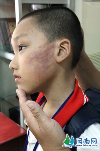 6名小学生惹怒年轻老师 被罚互打耳光脸颊红肿